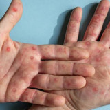 CDC: Korban Jiwa Akibat Mpox Sejak Awal 2024 Melampaui Angka 1.100