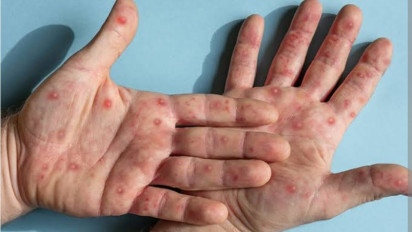 CDC: Korban Jiwa Akibat Mpox Sejak Awal 2024 Melampaui Angka 1.100