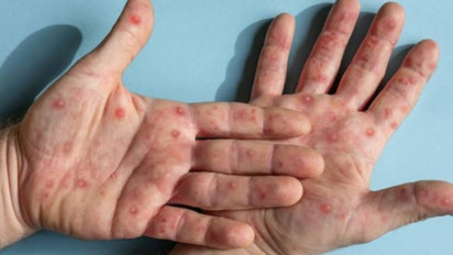 Waspada Gejala Awal Monkeypox: Ruam, Demam, dan Nyeri? Ini Langkah Medis yang Harus Dilakukan