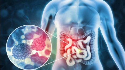 Generasi X Rentan Kanker Usus! Kenali Faktor Risiko dan Gejalanya