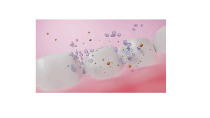 Marini Zumarnis Bebaskan Gigi dari Karang dengan Dental Spa di Devya Dental Clinic