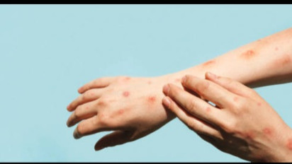 22 Siswa SMP Negeri 8 Tangsel Terkena Cacar Air, Pembelajaran Jarak Jauh Diterapkan