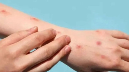 Kemenkes Segera Terbitkan Surat Edaran Menyusul Kasus Cacar Air Massal di Tangerang Selatan