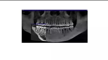 Gigi goyang adalah salah satu masalah kesehatan gigi yang sering dianggap sepele, padahal bisa berdampak besar pada kualitas hidup seseorang.