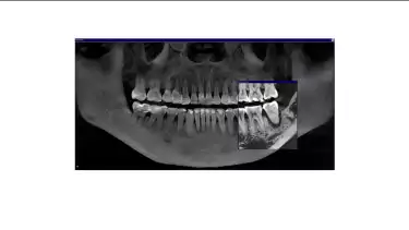 Gigi goyang adalah salah satu masalah kesehatan gigi yang sering dianggap sepele, padahal bisa berdampak besar pada kualitas hidup seseorang.