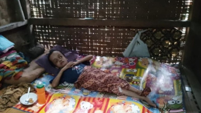 Gadis Penderita Hidrosefalus dari Lebak Butuh Bantuan Berobat