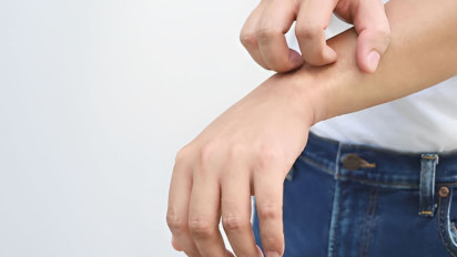 7 Pilihan Obat Biduran yang Ampuh dan Tersedia di Apotek