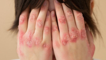 Tiga Cara Mudah Atasi Alergi, dr Zaidul Akbar Sarankan Lakukan Ini