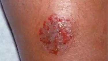 Eksim tak kunjung sembuh yang ternyata bisa dipicu oleh masalah infeksi gigi.