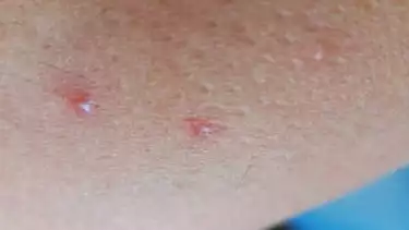 Ilustrasi kondisi jerawat dan bisul setelah Wudhu hendak shalat