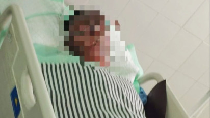 Nahas, Main Petasan Berujung Petaka, Remaja di Driyorejo Gresik Alami Luka Bakar