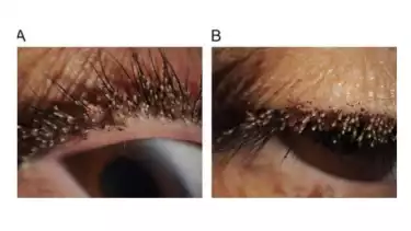 Kondisi mata seorang wanita di Hangzhou, Tiongkok setelah terpapar parasit aneh