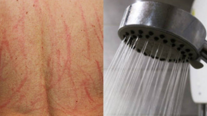 Badan Bekas Kerokan Akibat Masuk Angin, Haruskah Menunda Mandi Junub? Buya Yahya Menjawab Tegas soal Hukumnya