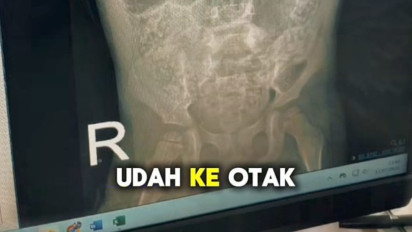 Nasib Pilu Anak di Sukabumi Meninggal Dunia Gara-Gara Cacingan Akut, Cacing 15 Cm Bisa Ditarik dari Lubang Hidung, Bapak Sakit dan Ibu ODGJ