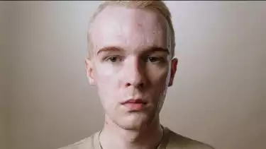 ilustrasi wajah berjerawat