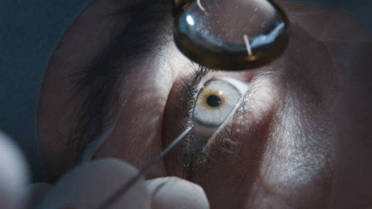 Mengenal Penyebab, Cara, dan Pencegahan Katarak: Operasi Katarak Gratis Digelar untuk Puluhan Pasien Sebagai Kepedulian Harapan Hidup yang Lebih Produktif