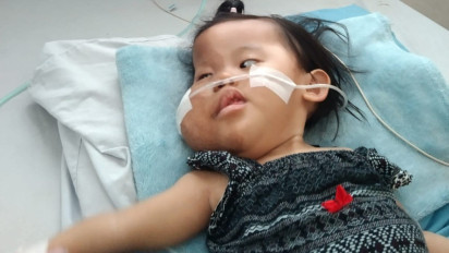 Belum Ada Bantuan Pemerintah, Balita di Probolinggo Derita Penyakit Langka Sindrom Proteus