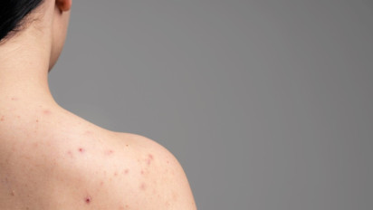 Banyak Jerawat, Bukan di Wajah, tapi di Punggung! Bisa Dihilangkan Sendiri di Rumah, Dokter Bilang Caranya...