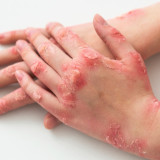 Moms Harus Tahu, Inilah Ciri-ciri Alergi Gluten dan Cara Pertolongan Pertama pada Anak dan Dewasa