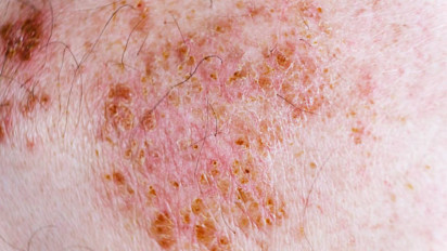 Muncul Bintik-bintik Merah di Kulit usai Hujan, Intip Cara Mengatasi Herpes Alami Tanpa Obat Kimia, Jos Banget!