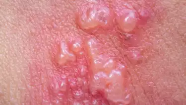 Ilustrasi herpes di kulit