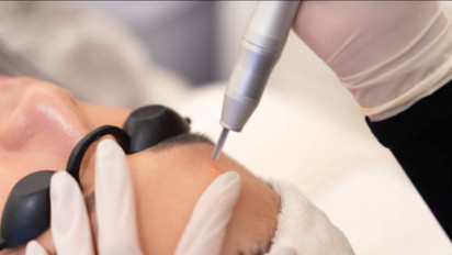 Kulit Glowing Sekejap? Ini Teknologi Laser Baru yang Jadi Rahasia Wajah Flawless, Berkilau, dan Cantik Alami!