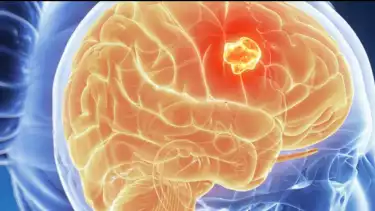 Mengenal Kanker Otak yang Sempat Dialami Epy Kusnandar, Begini Gejala yang Perlu Diwaspadai