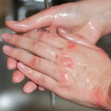 Sering Keliru, Begini Cara Memberikan Pertolongan Pertama Luka Bakar Agar Tidak Memperparah Kondisi Korban