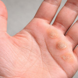 Bagaimana Cara Menghilangkan Kapalan di Telapak Tangan? Ini 9 Solusi Alami dari Cuka Apel hingga Batu Apung