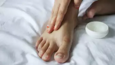 ilustrasi obat kutu air