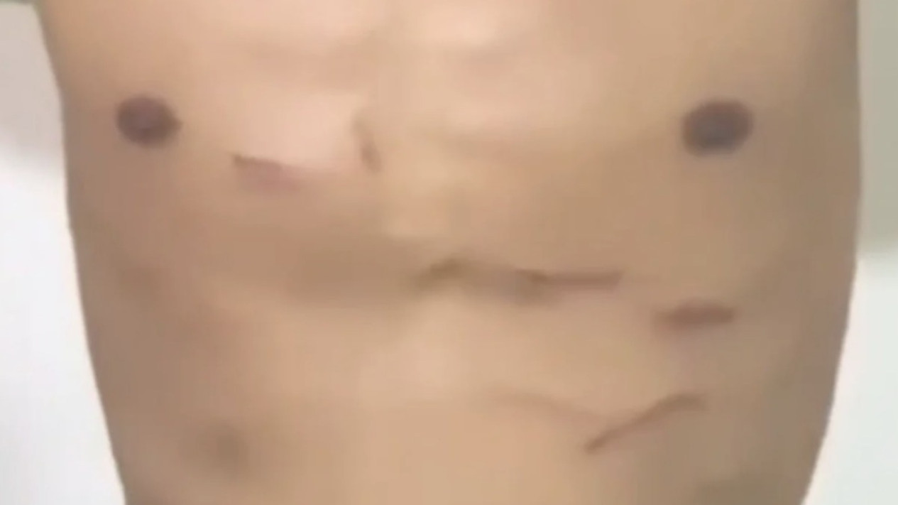 Bekas Luka Tendangan "Kungfu" Pemain Liga 4 PS Putra Jaya Hilman Gimnastiar
            - galeri foto