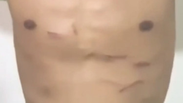 Bekas Luka Tendangan "Kungfu" Pemain Liga 4 PS Putra Jaya Hilman Gimnastiar