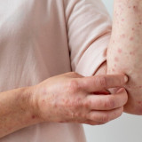 Kasus Viral Dokter Meninggal karena Campak, Ini Penjelasan Resmi Kemenkes