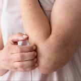 Tips Cepat Atasi Kulit Gatal Setelah Kehujanan