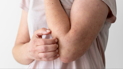 Tips Cepat Atasi Kulit Gatal Setelah Kehujanan