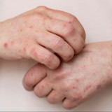 Campak Bisa Berakibat Fatal, Begini Dampaknya Jika Tidak Ditangani dengan Tepat