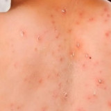 Keluyuran saat Terinfeksi Campak, Selebgram Ruce Nuenda Minta Maaf