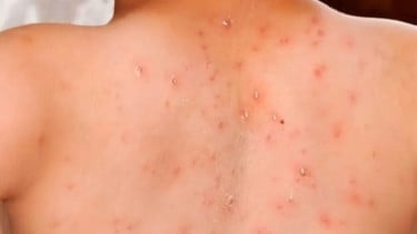 Keluyuran saat Terinfeksi Campak, Selebgram Ruce Nuenda Minta Maaf