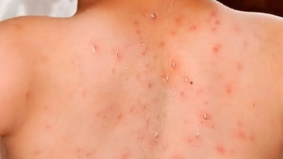 Keluyuran saat Terinfeksi Campak, Selebgram Ruce Nuenda Minta Maaf