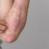 Waspada Penularan Campak Saat Idulfitri, Jangan Sembarangan Menggendong atau Menyentuh Anak!