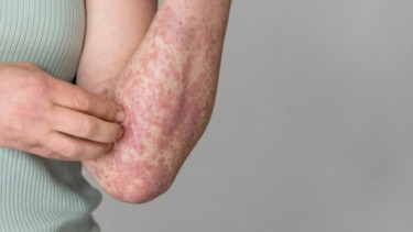 Waspada Penularan Campak Saat Idulfitri, Jangan Sembarangan Menggendong atau Menyentuh Anak!