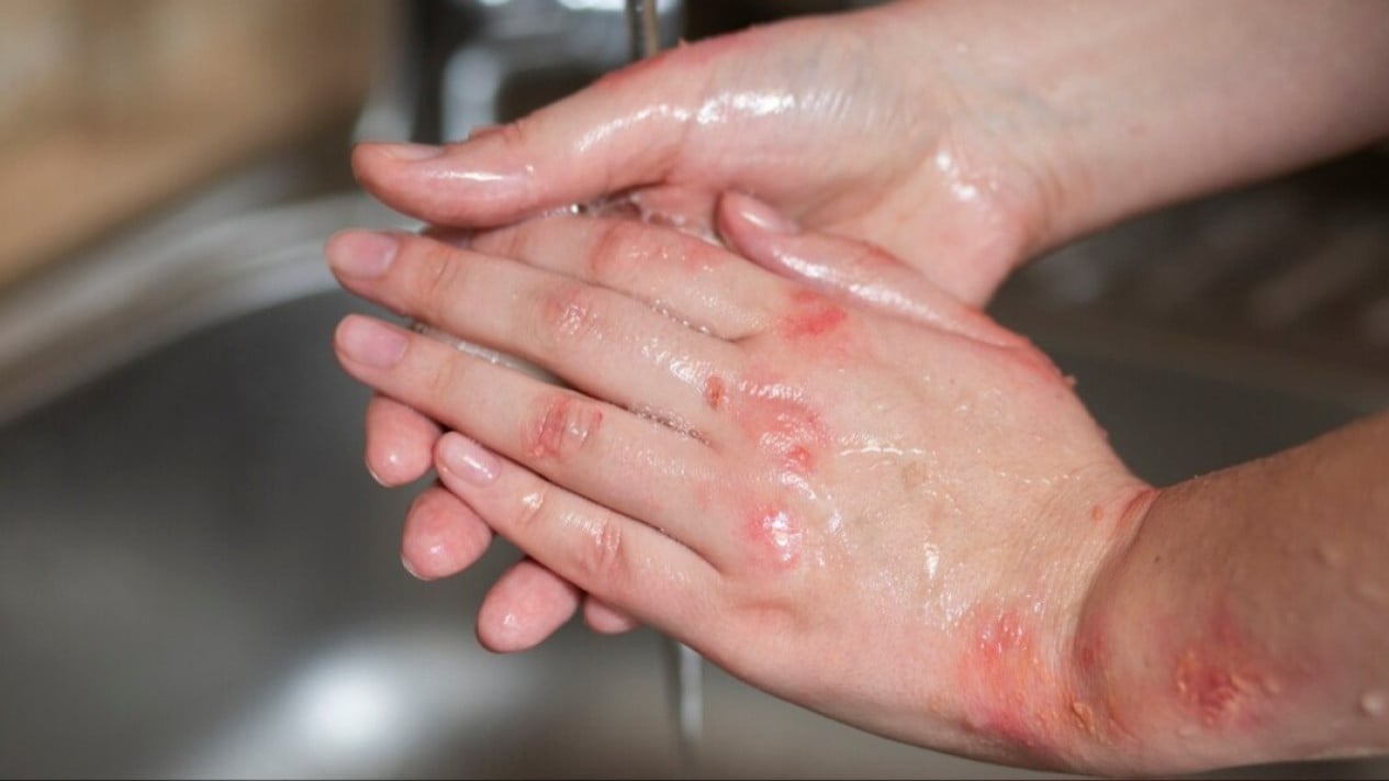 Kasus Aktivis Disiram Air Keras, Dokter Jelaskan Langkah Pertolongan Pertama Jika Mengalami Hal Serupa
            - galeri foto