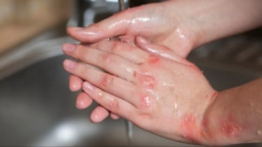 Kasus Aktivis Disiram Air Keras, Dokter Jelaskan Langkah Pertolongan Pertama Jika Mengalami Hal Serupa