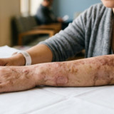 Mengapa Luka Air Keras Susah Sembuh dan Tinggalkan Bekas Jangka Panjang? Begini Penjelasannya