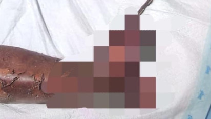 Kaki Pemuda di Pamekasan Hancur Akibat Ledakan saat Merakit Petasan