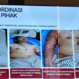 Terungkap, Kondisi Terkini hingga Penampakan Luka Bakar Aktivis KontraS yang Disiram Air Keras