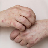 Jangan Remehkan! Satu Dokter Meninggal karena Campak, Masyarakat Diimbau Segera Vaksin