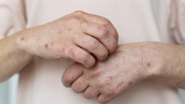 Jangan Remehkan! Satu Dokter Meninggal karena Campak, Masyarakat Diimbau Segera Vaksin