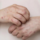 Jangan Remehkan! Satu Dokter Meninggal karena Campak, Masyarakat Diimbau Segera Vaksin