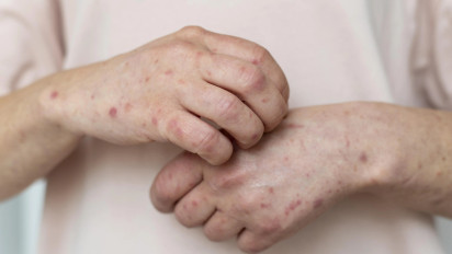 Jangan Remehkan! Satu Dokter Meninggal karena Campak, Masyarakat Diimbau Segera Vaksin